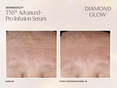 The image displays a side-by-side comparison of a person s skin before and after treatment with Diamond Glow, showcasing the results of an advanced infusion serum from SkinMedica.
