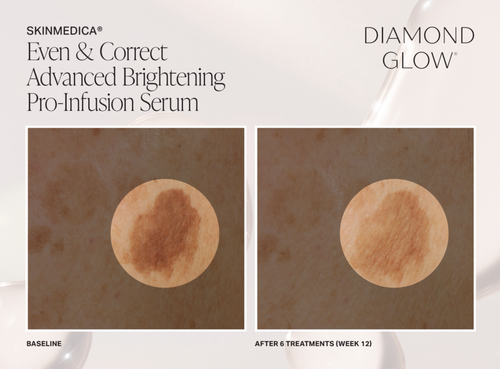 The image displays two photographs side by side, showcasing a skincare product labeled  DIAMOND GLOW  with text indicating its use for advanced brightening pro-infusion serum. It appears to be an advertisement featuring before and after skin treatments.