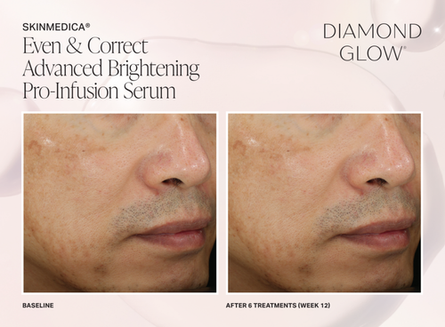 The image shows a before-and-after comparison of skin treatments, with the left side showing a person s face with visible blemishes and the right side showing the same person s face after receiving a treatment, suggesting improved skin condition.
