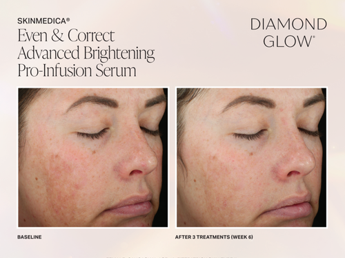 The image shows a before-and-after comparison of a person s skin, highlighting the effectiveness of a skincare product named  DIAMOND GLOW  for advanced brightening pro-infusion serum.