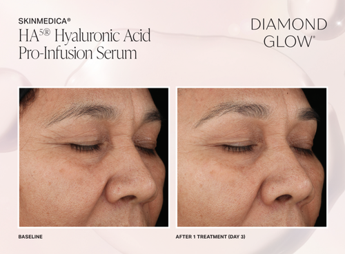 The image shows a side-by-side comparison of a person s skin before and after treatment with HydroGlow Hyaluronic Acid Infusion Serum, highlighting the difference between the two states of the skin.