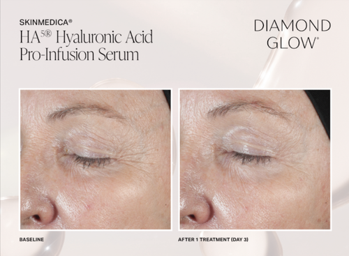 The image shows a split-screen comparison of a person s skin before and after treatment with HydroPeptide Hyaluronic Acid Pro-Infusion Serum, highlighting the product s efficacy in reducing wrinkles and improving skin appearance.