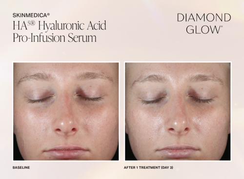 The image shows two side-by-side photographs of a person s face with closed eyes, before and after treatment, likely for cosmetic purposes. The left photo appears to show the skin with some blemishes or imperfections, while the right photo shows the same area of skin looking clearer and smoother. There is text at the top that reads  HA  followed by  HYALURONIC ACID PRO-INFLUSSION SERUM  and at the bottom, it says  DIAMOND GLOW.  The brand name  SKINMEDICA  is visible, along with the product s name.