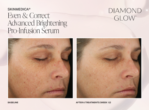 The image shows two side-by-side photographs of a person s face with noticeable skin changes after receiving advanced brightening pro-infusion serum, accompanied by text that suggests before-and-after comparison for skincare product promotion.