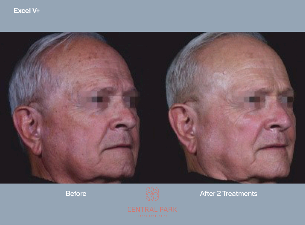 The image shows two side-by-side photographs of an older man s face with visible signs of aging, before and after a cosmetic treatment, likely at a clinic named  Central Park.