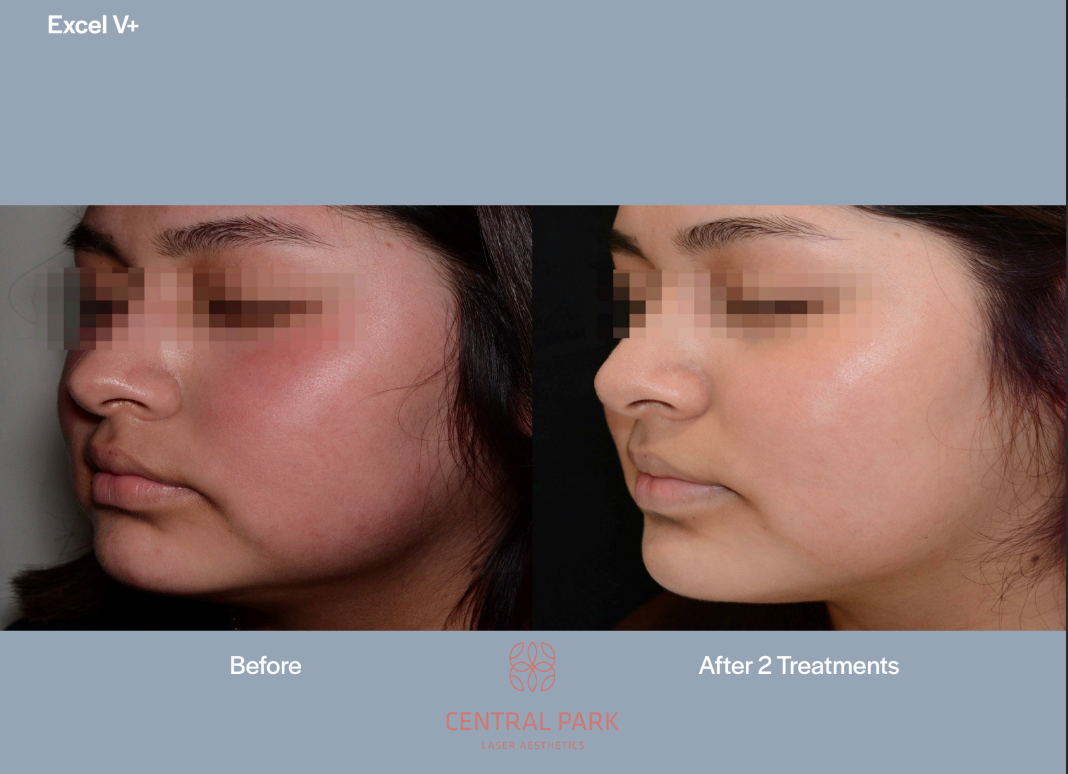 The image shows a before-and-after comparison of a person s skin after treatments at a cosmetic clinic, with text indicating the name of the clinic and the treatment provided.