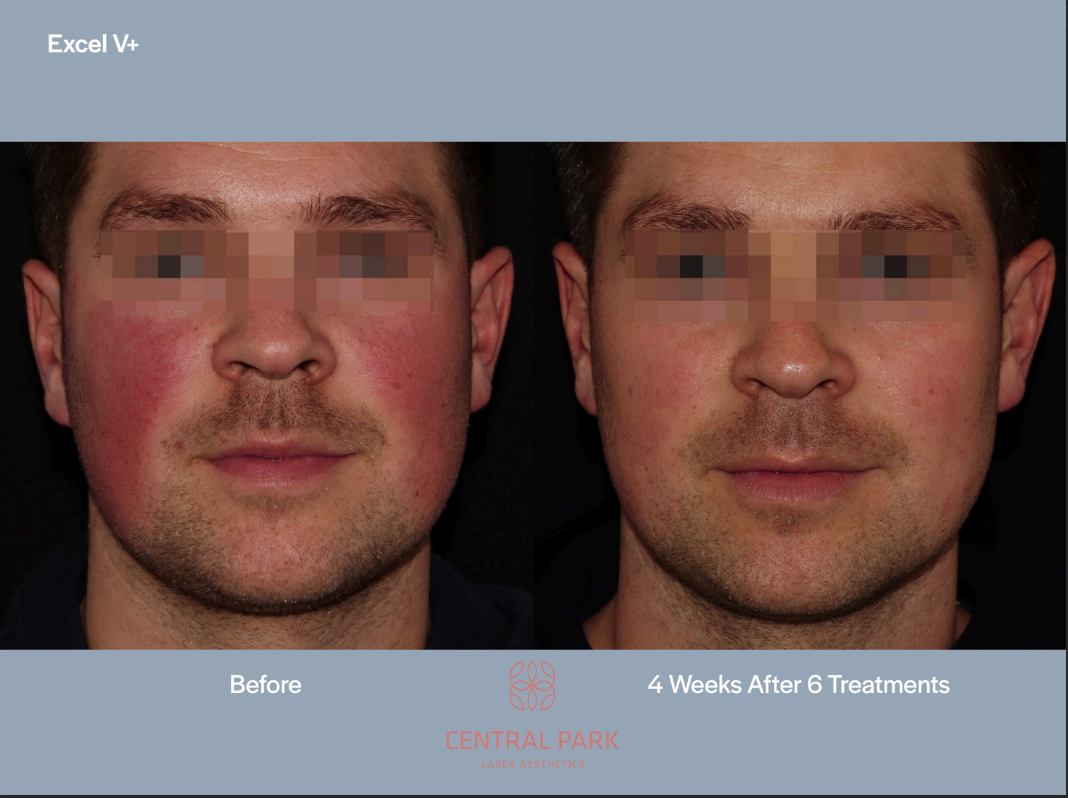The image is a before-and-after comparison of a man s skin condition, likely for cosmetic treatment promotion, with a redacted area around his nose and cheeks highlighting the results of treatment.