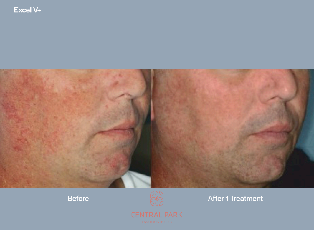 The image shows a side-by-side comparison of a person s skin before and after treatment, highlighting the effectiveness of a treatment for acne or similar skin conditions.