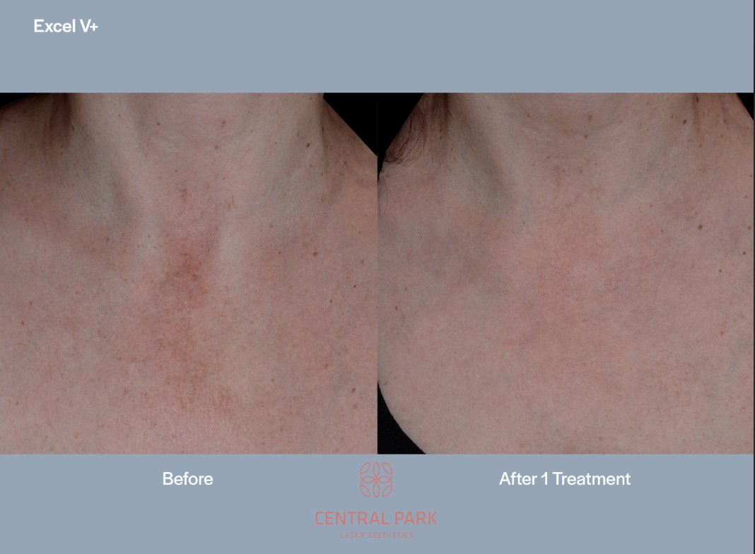 The image shows a before-and-after comparison of skin treatment results, with the left side showing a person s neck with visible skin imperfections and the right side displaying the same area after treatment, appearing smoother and clearer.