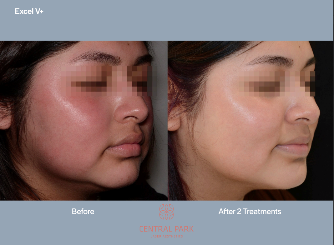 The image shows two photographs side by side  on the left, a close-up of a person s face with visible acne, and on the right, the same face after treatment, appearing clearer. The acne is highlighted in red circles, suggesting before and after comparison for cosmetic or dermatological purposes.