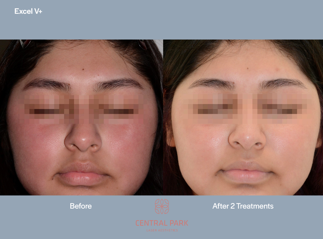 The image shows a side-by-side comparison of a person s skin before and after cosmetic treatments, with a focus on acne treatment at a specific location named  Central Park.