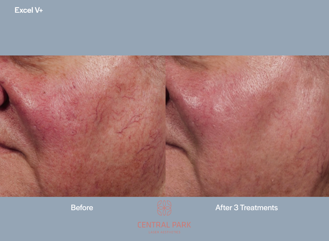 The image shows a close-up of a person s face with a visible skin treatment area, likely before and after a cosmetic procedure, indicated by a text overlay that reads  BEFORE  and  AFTER,  with an arrow pointing from one to the other.