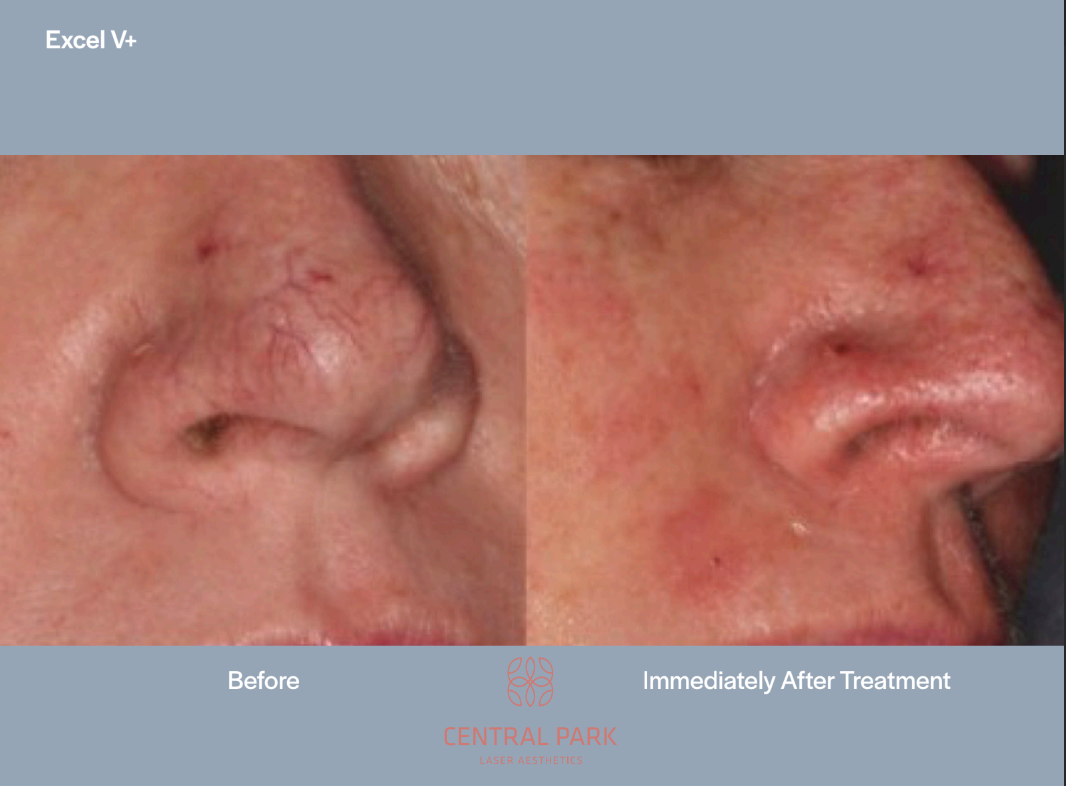 The image shows a close-up comparison of a person s nose before and after a cosmetic procedure, with text indicating an improvement in appearance after treatment.