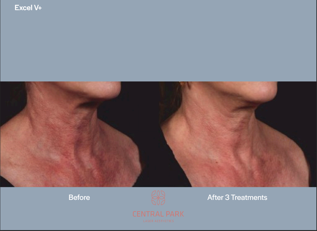 The image shows a before-and-after comparison of skin treatments, with visible improvements in the after photo.