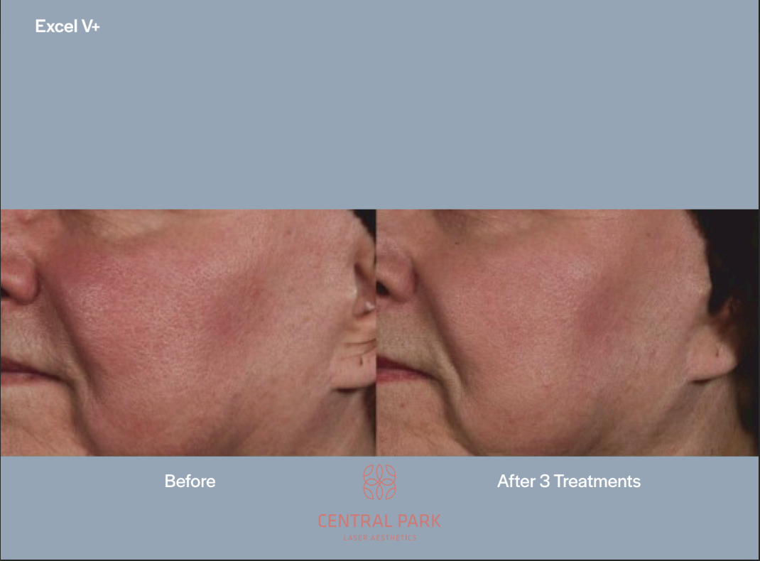 The image shows a close-up of a person s face with visible skin imperfections before and after treatment, indicating cosmetic dermatology services offered at Central Park Clinic, as indicated by the text in the image.