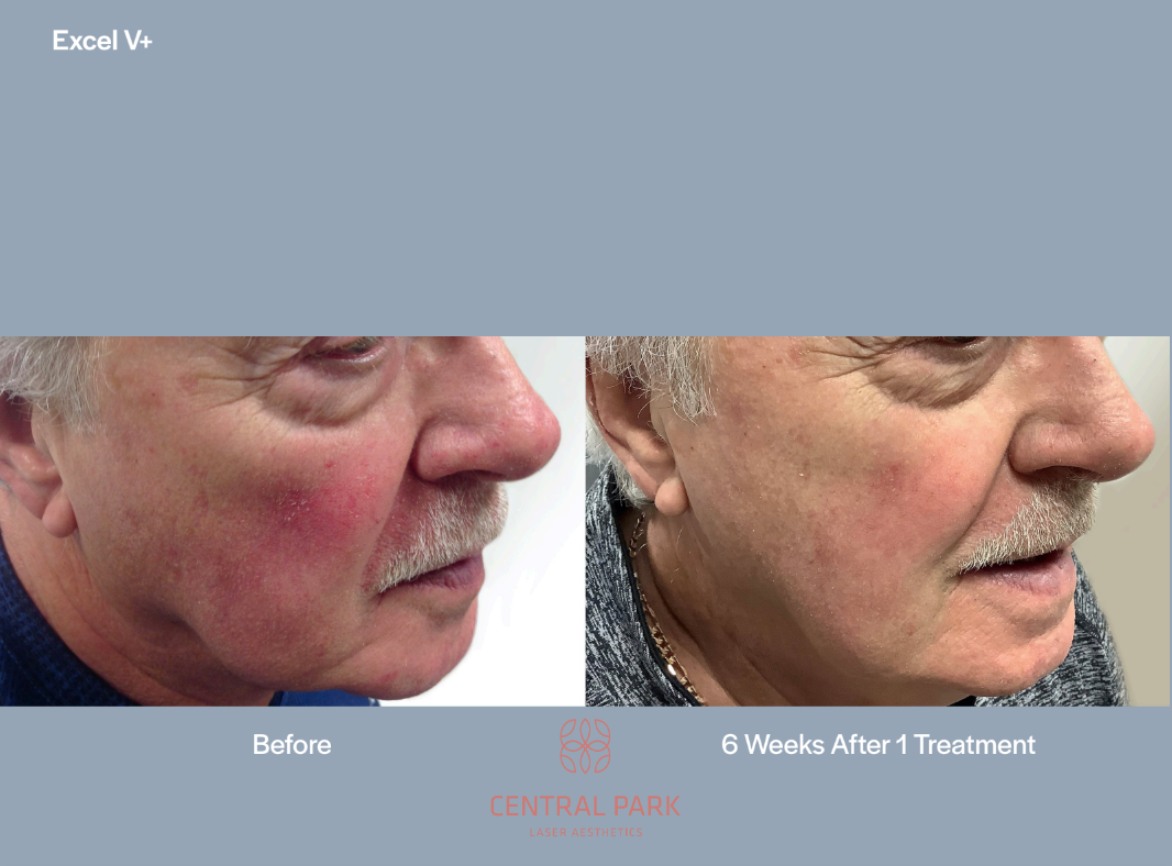 The image shows two photos side by side  on the left, there is a close-up of a person s face with visible skin issues, and on the right, the same person appears after treatment, showing improved skin condition.