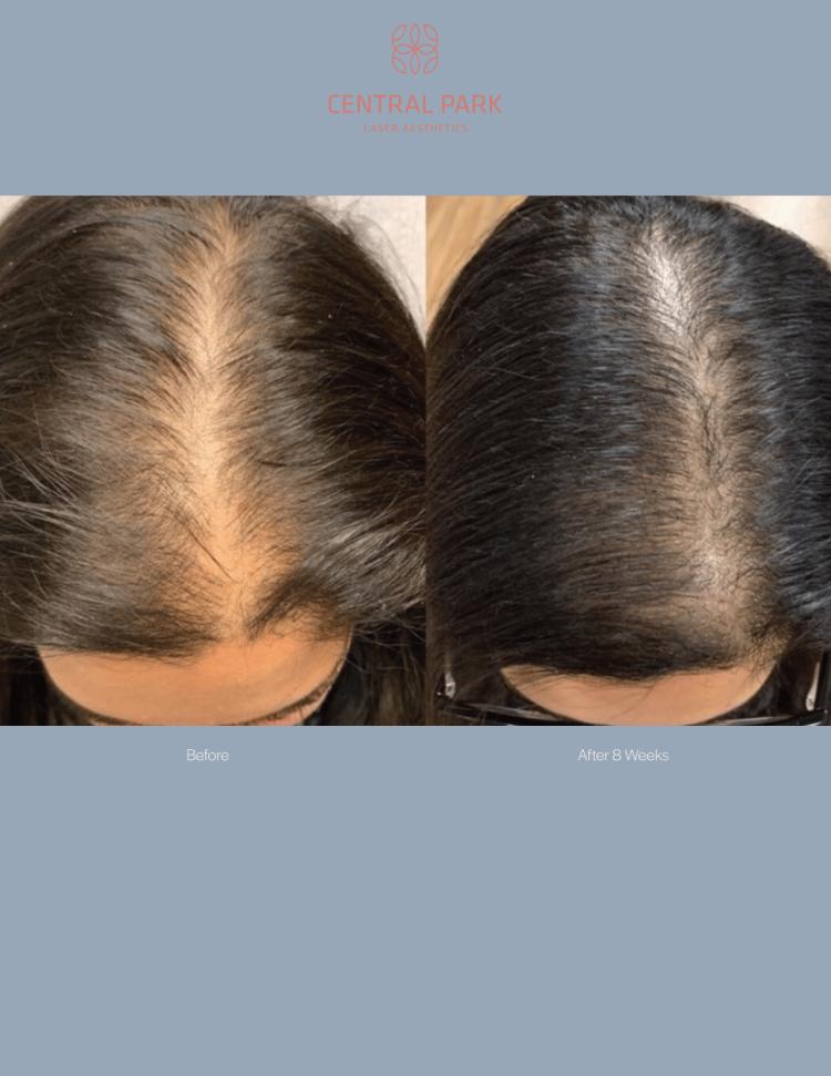 Central Park Laser Aesthetics | Chemical Peel Treatment, Dermal Fillers and Tattoo Removal