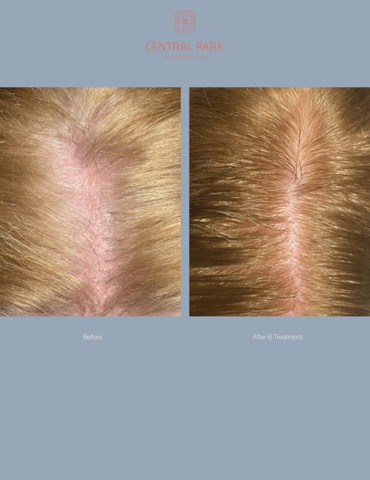 Central Park Laser Aesthetics | Botox, Masseter Botox For Teeth Grinding and Double Chin Treatment