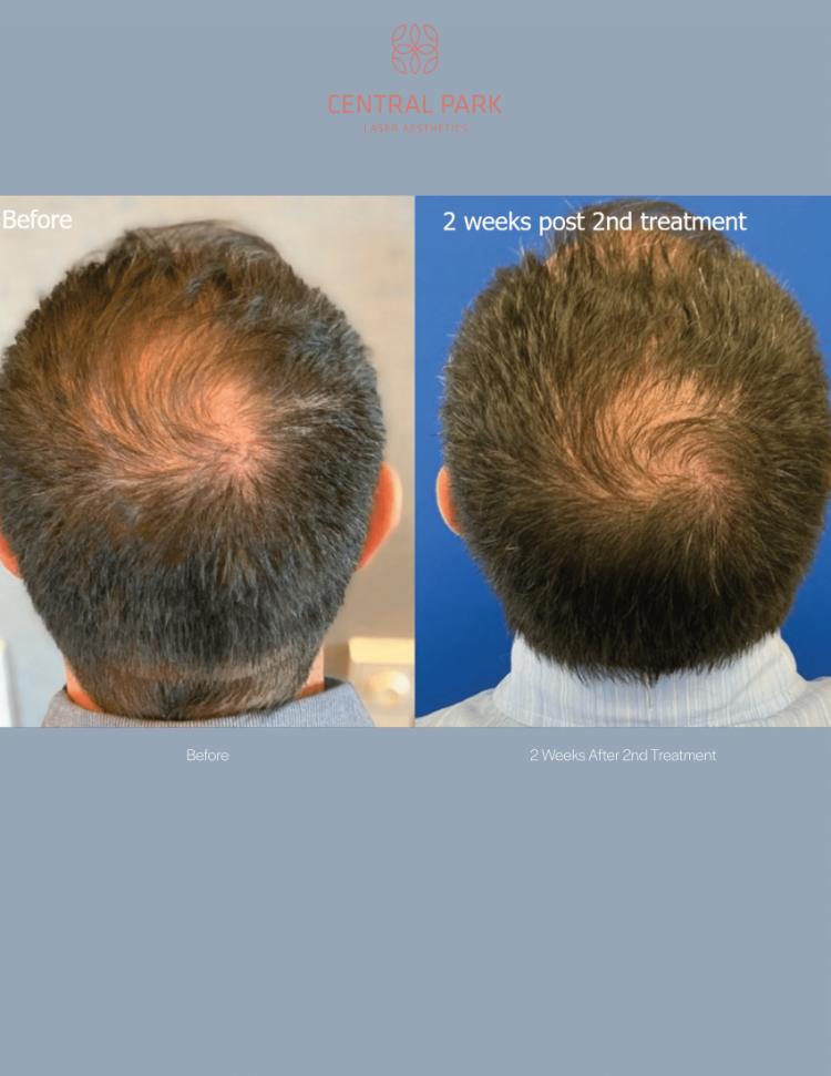 Central Park Laser Aesthetics | Dark Spots Treatment, Tattoo Removal and KeraDuo Hair Regrowth