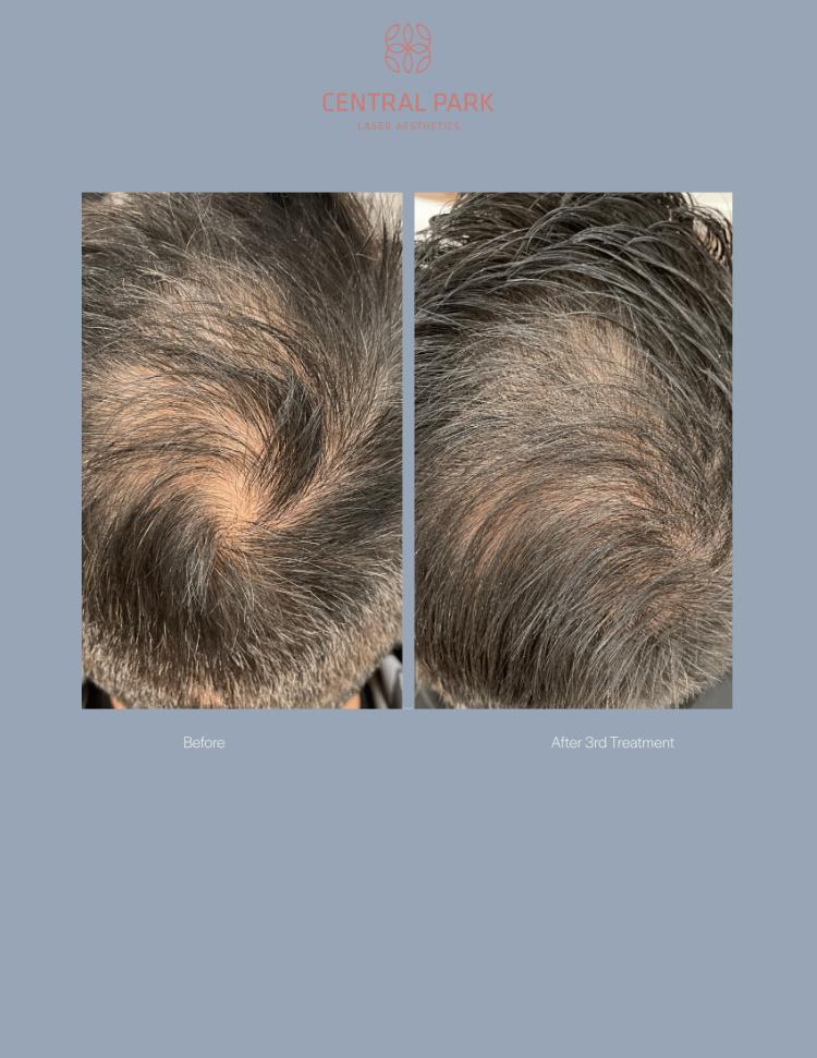 Central Park Laser Aesthetics | Laser Hair Removal, Botox For Sweating Treatment and Co2 Laser Resurfacing