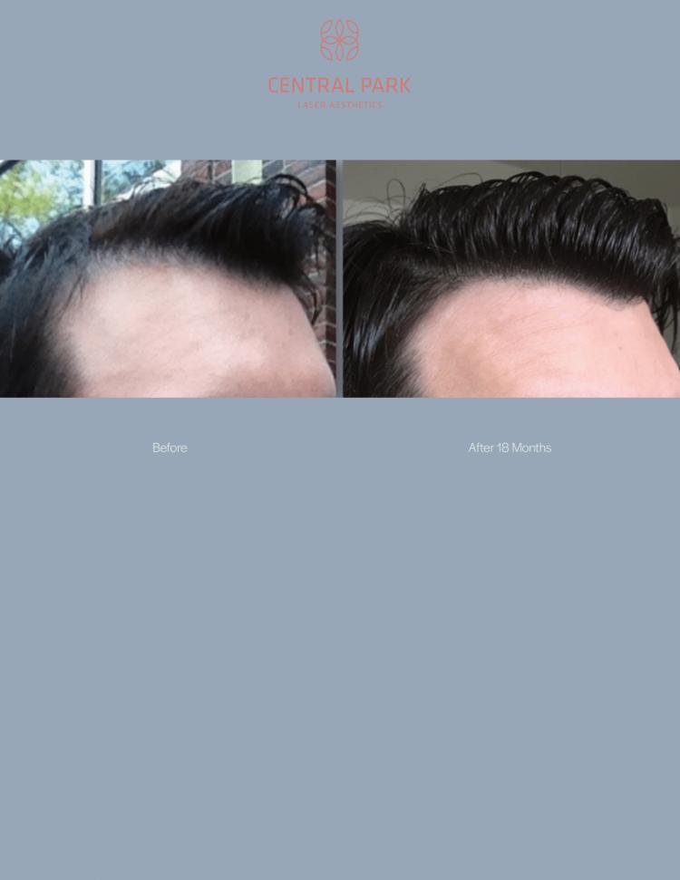 Central Park Laser Aesthetics | Hyperpigmentation Treatment, Excel reg  V    Laser Genesis and Acne Treatment