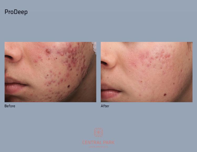 Central Park Laser Aesthetics | Chemical Peel Treatment, Dermal Fillers and Tattoo Removal