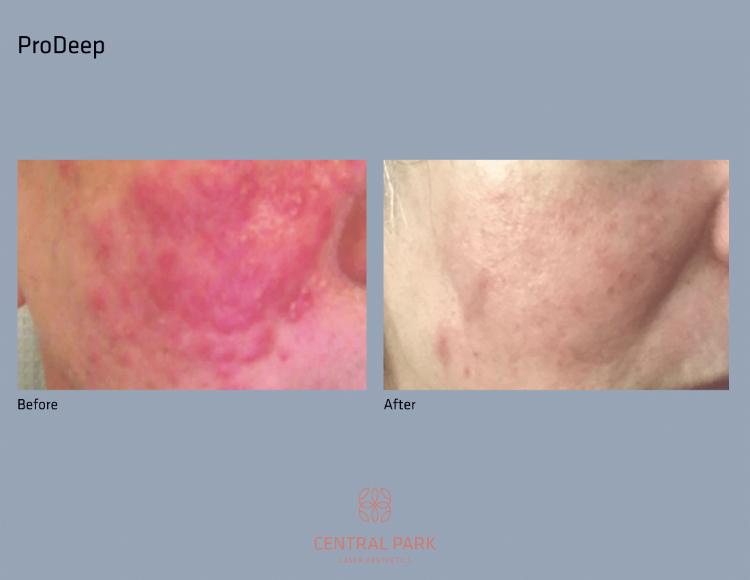 Central Park Laser Aesthetics | Tattoo Removal, Glass Facial and Botox
