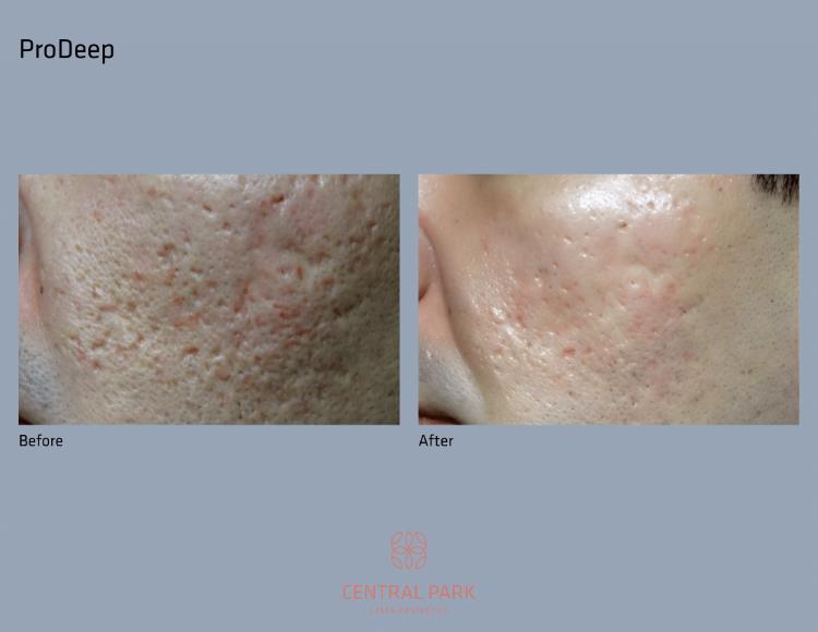 Central Park Laser Aesthetics | Botox, Masseter Botox For Teeth Grinding and Double Chin Treatment