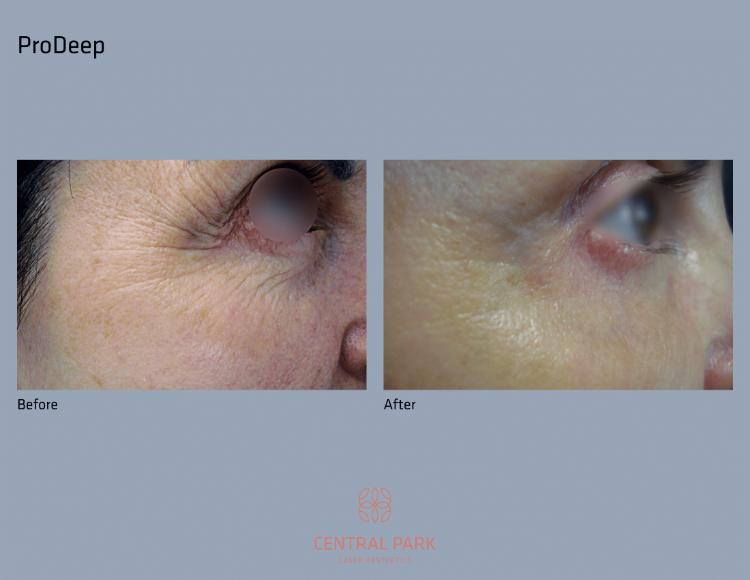 Central Park Laser Aesthetics | Dark Spots Treatment, Tattoo Removal and KeraDuo Hair Regrowth