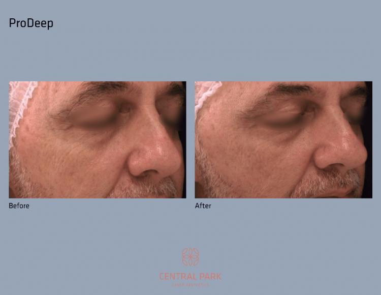 Central Park Laser Aesthetics | Laser Hair Removal, Botox For Sweating Treatment and Co2 Laser Resurfacing