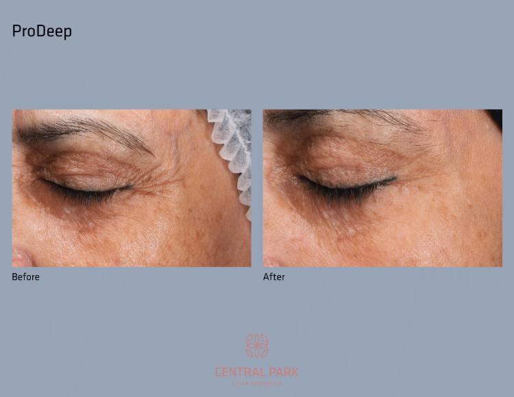 Central Park Laser Aesthetics | Hyperpigmentation Treatment, Excel reg  V    Laser Genesis and Acne Treatment