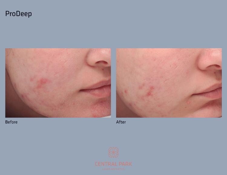 Central Park Laser Aesthetics | Acne Scar Treatment, SKINVIVE    and Chemical Peel Treatment