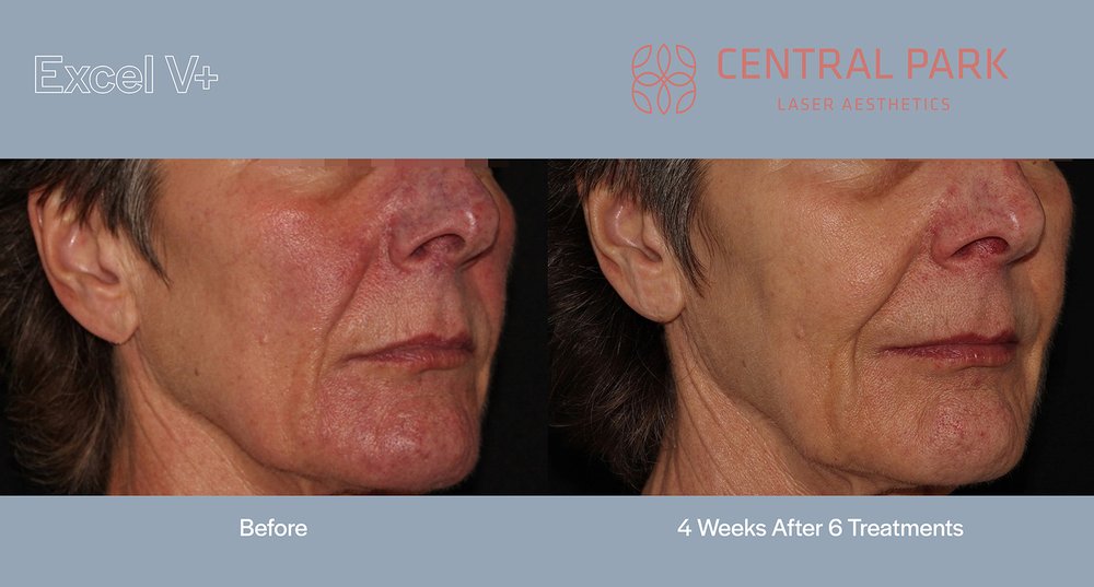 The image shows a before-and-after comparison of a person s facial skin, with the left side showing the skin condition before treatment and the right side showing the improved skin after treatment, likely at a medical or cosmetic facility named  Central Park.