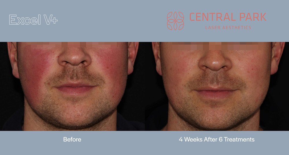 The image shows a close-up of a person s face with a focus on their skin, before and after treatment, with text indicating a six-week timeframe for results and a reference to  Central Park Laser Aesthetics.