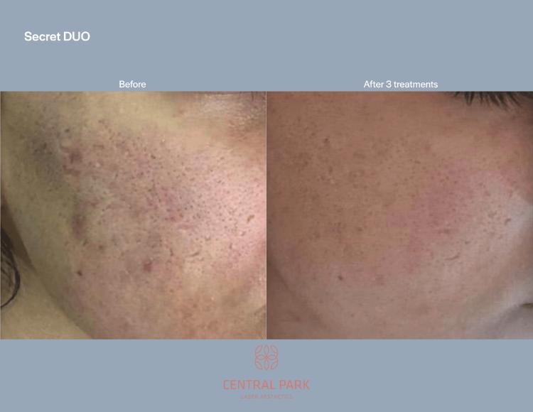 Central Park Laser Aesthetics | Chemical Peel Treatment, Dermal Fillers and Tattoo Removal