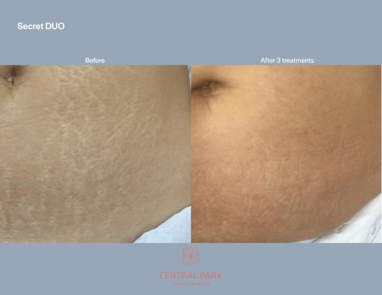 Central Park Laser Aesthetics | Tattoo Removal, Glass Facial and Botox