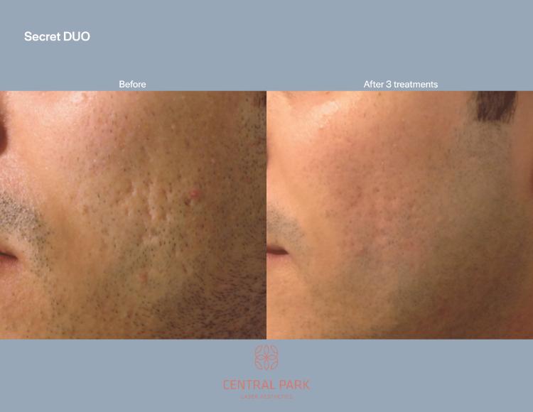 Central Park Laser Aesthetics | Botox, Masseter Botox For Teeth Grinding and Double Chin Treatment
