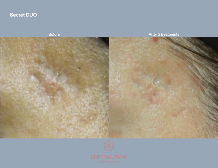 Central Park Laser Aesthetics | Dark Spots Treatment, Tattoo Removal and KeraDuo Hair Regrowth