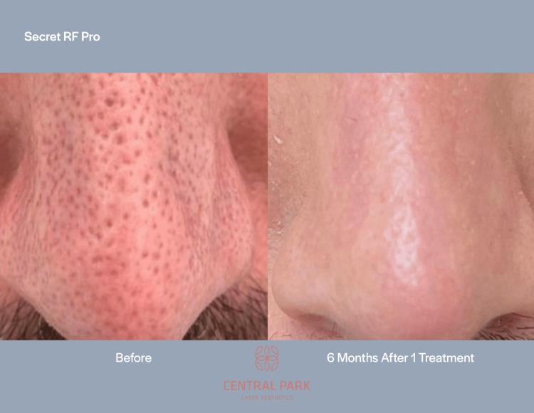 Central Park Laser Aesthetics | Chemical Peel Treatment, Dermal Fillers and Tattoo Removal