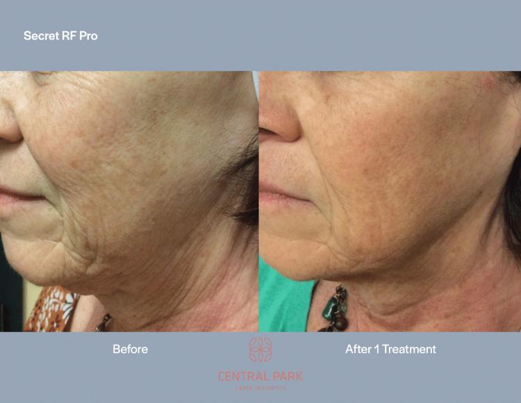 Central Park Laser Aesthetics | Botox For Migraines, Hyperpigmentation Treatment and DiamondGlow reg  Medical Grade Facial