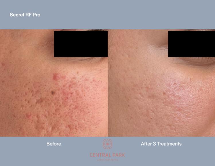 Central Park Laser Aesthetics | Dermal Fillers, Botox For Migraines and Masseter Botox For Teeth Grinding