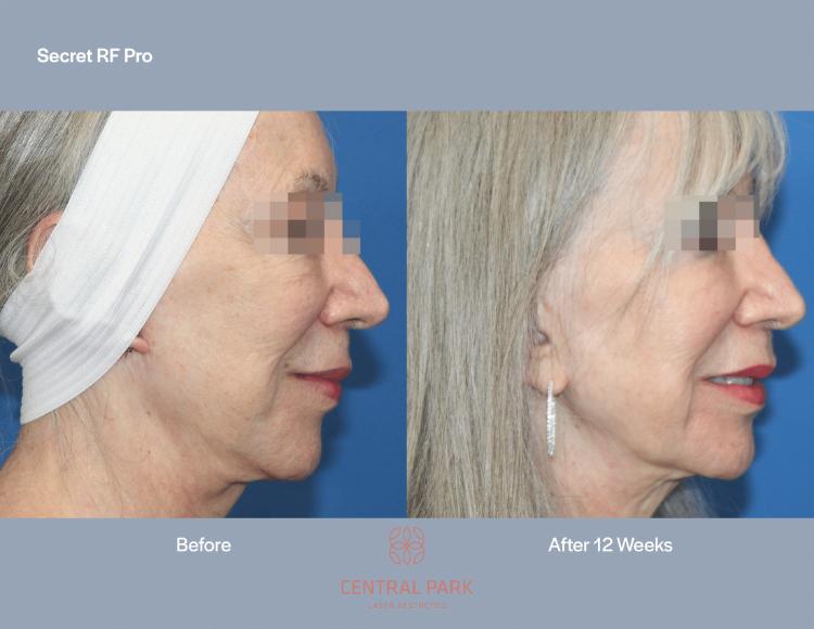 Central Park Laser Aesthetics | Acne Treatment, Skin Rejuvenation and Tattoo Removal