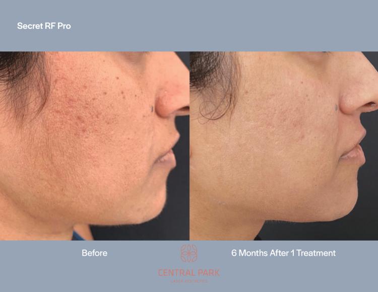 Central Park Laser Aesthetics | Tattoo Removal, Glass Facial and Botox