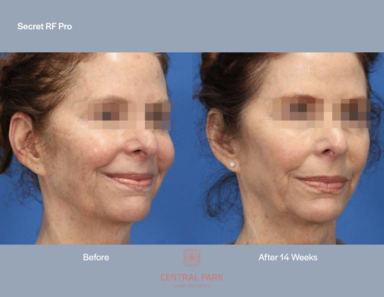 Central Park Laser Aesthetics | Laser Hair Removal, Botox For Sweating Treatment and Co2 Laser Resurfacing