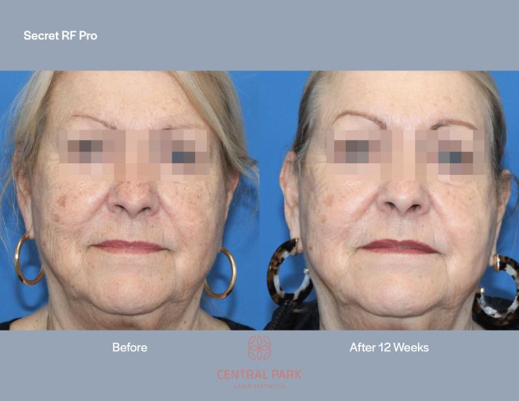 Central Park Laser Aesthetics | Hyperpigmentation Treatment, Excel reg  V    Laser Genesis and Acne Treatment