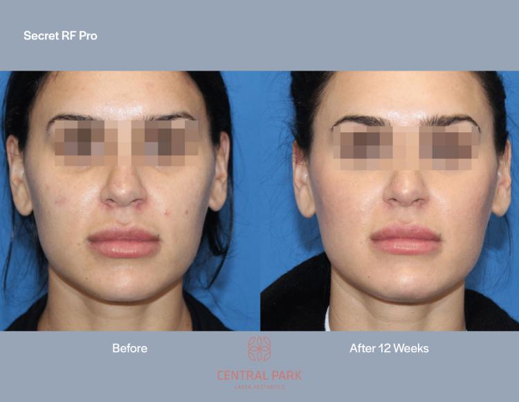 Central Park Laser Aesthetics | Acne Scar Treatment, SKINVIVE    and Chemical Peel Treatment