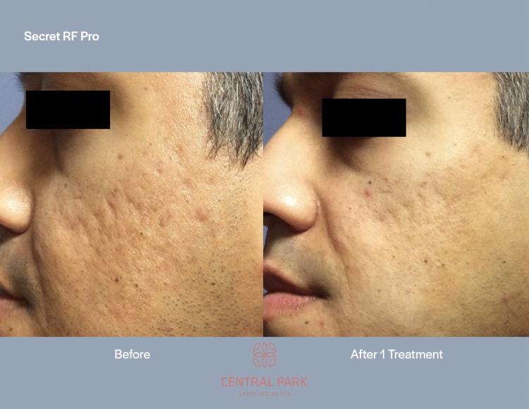 Central Park Laser Aesthetics | Sun Spots Treatment, Masseter Botox For Teeth Grinding and Injectables