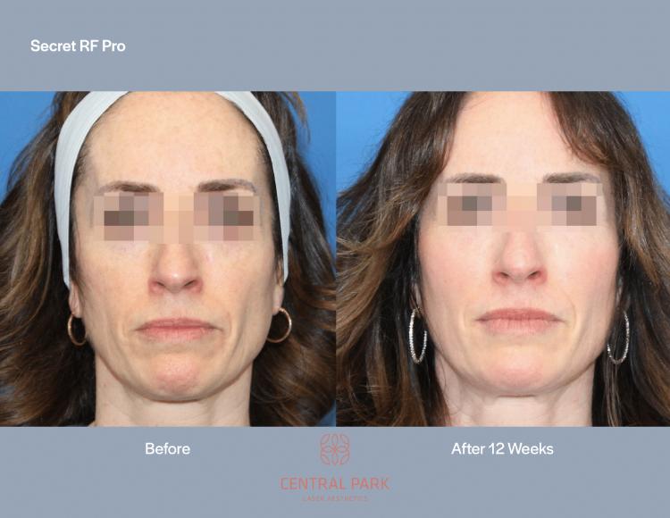 Central Park Laser Aesthetics | Laser Hair Removal, Secret PRO and Sun Spots Treatment
