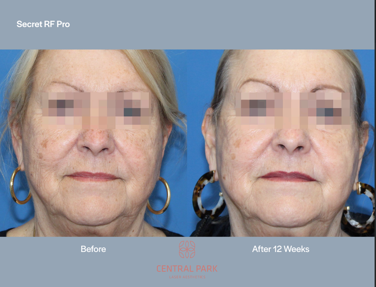 The image shows a woman with visible signs of aging on her face, before and after a cosmetic procedure, likely a facelift or skin rejuvenation treatment, indicated by the text  Secret RF Pro .