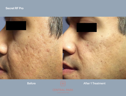 The image shows a split-screen comparison of a person s face before and after treatment, highlighting skin improvement with text indicating  Secret RF Pro  and  Before 1 treatment.